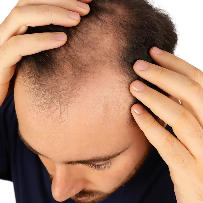 Couro cabeludo com rarefação capilar no topo da cabeça, padrão característico da alopecia androgenética