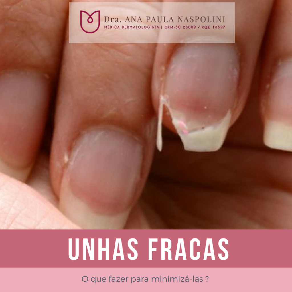 O que você precisa saber sobre UNHAS FRACAS – Dra. Ana Paula Naspolini ...
